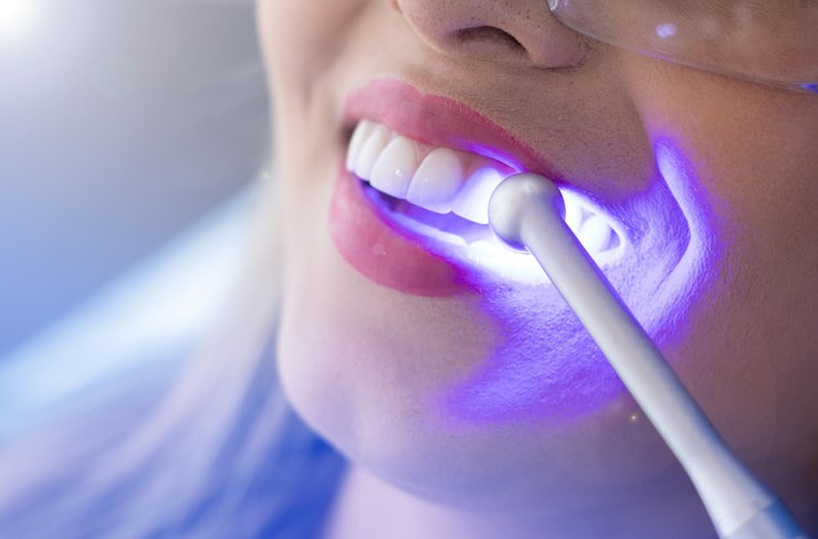 teeth whitening cost