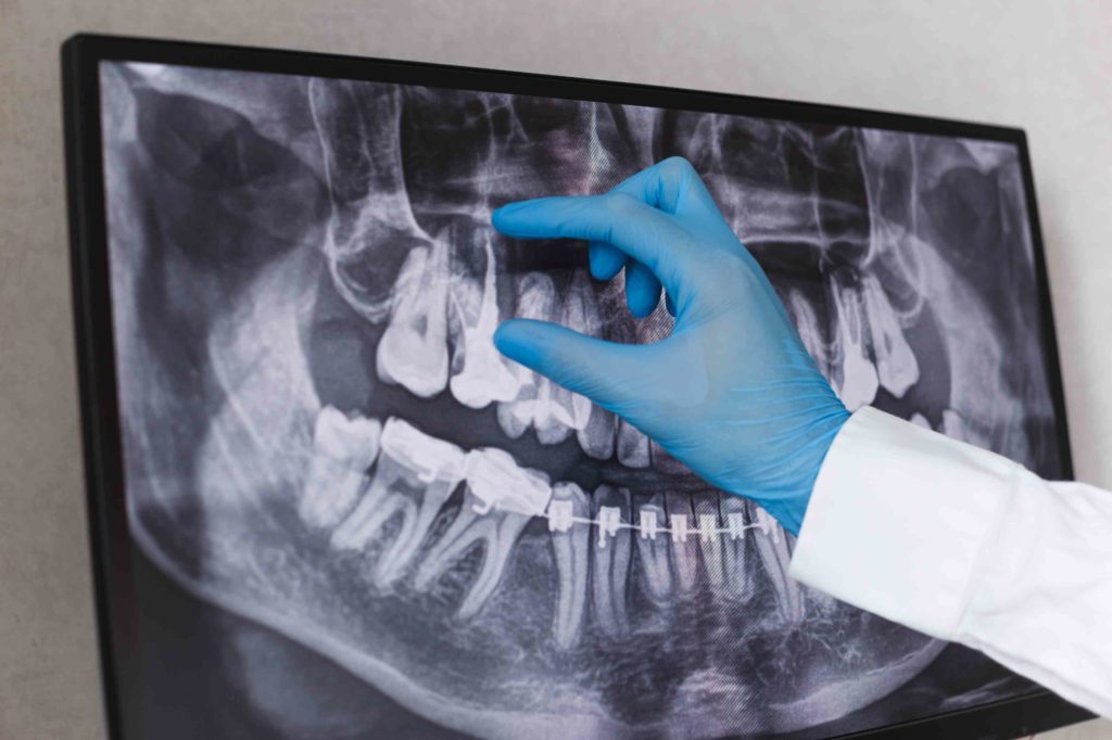 a dentist examining root canal x ray