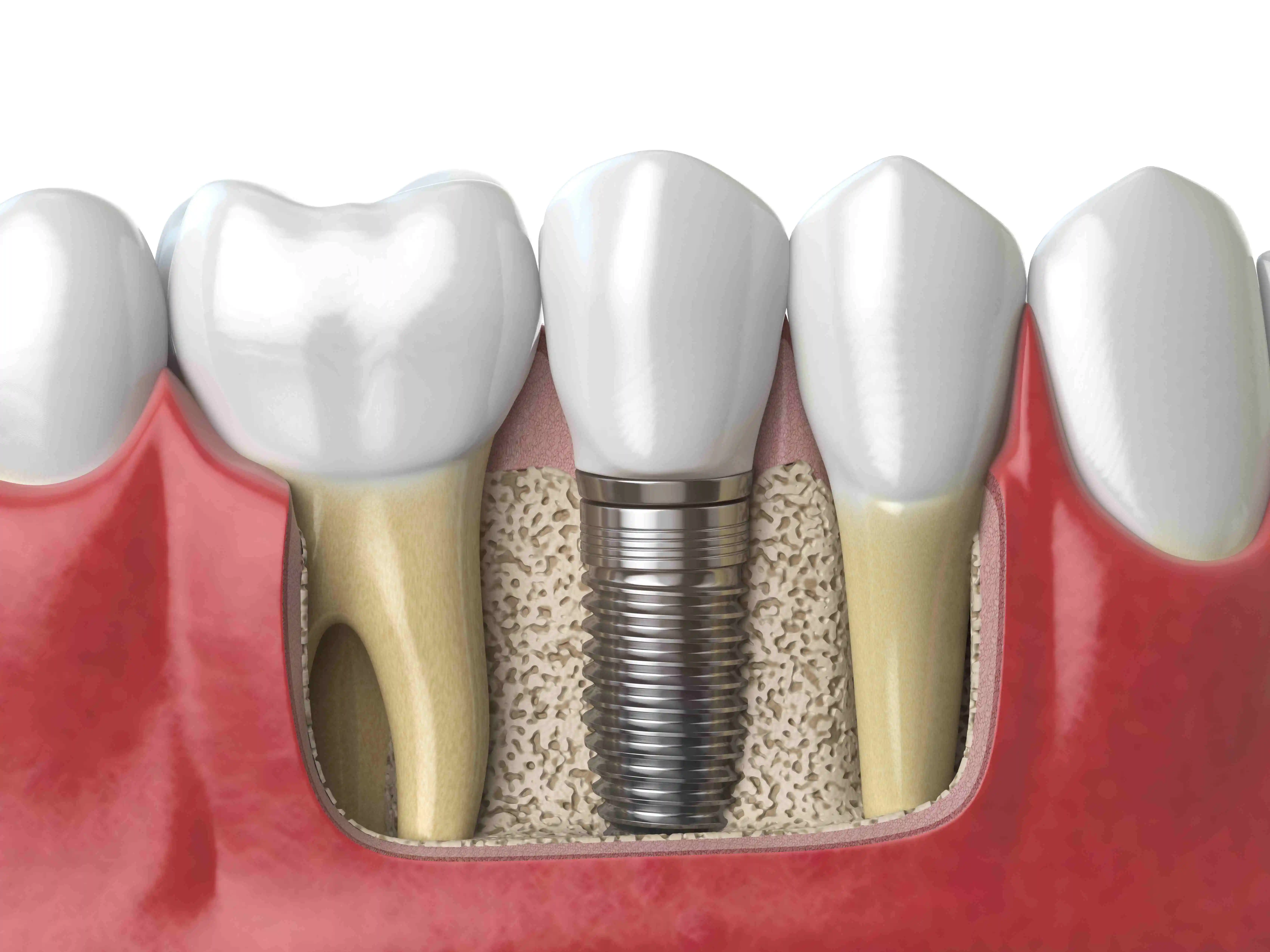 Truth About Dental Implant Pain