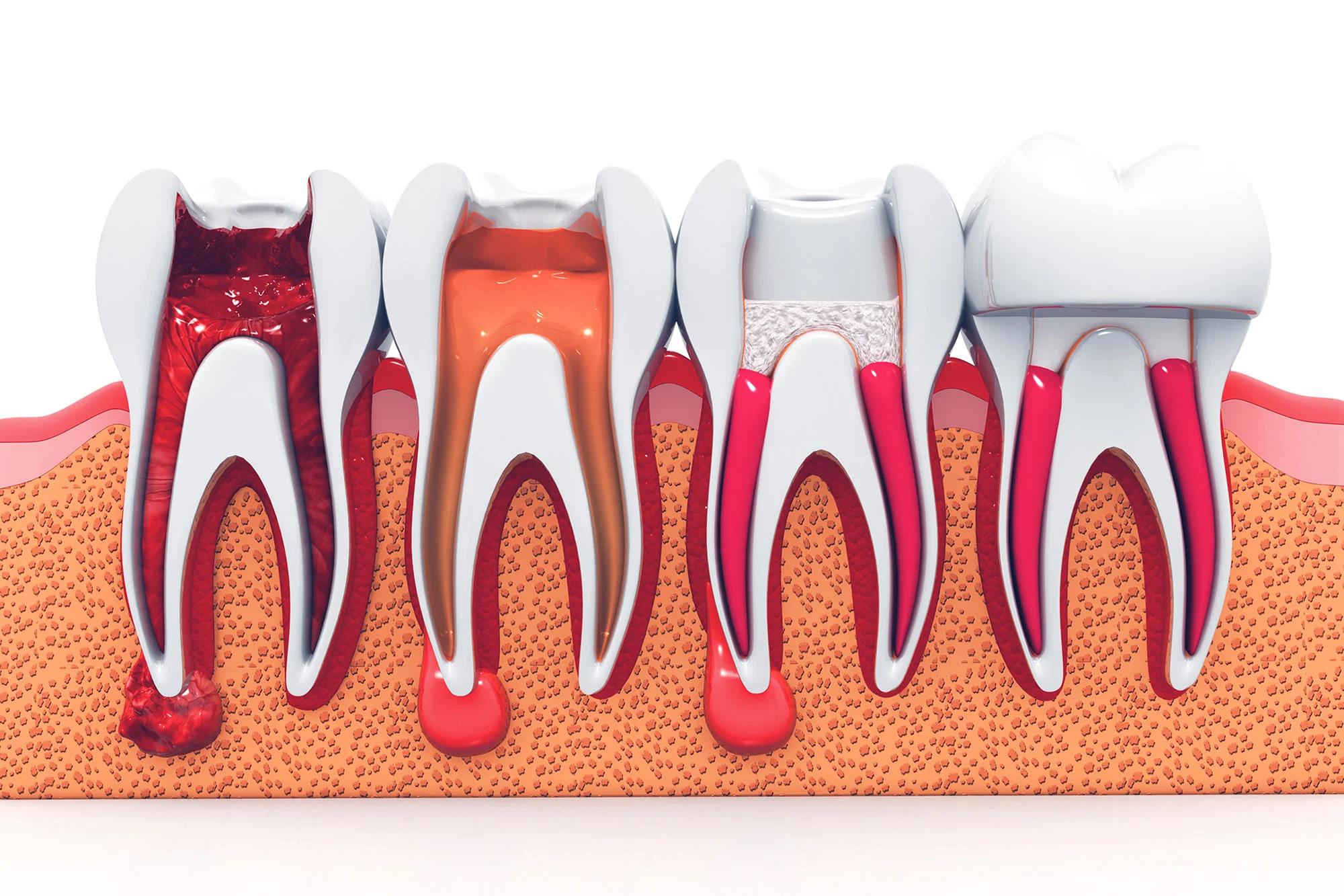 Root Canal Treatment at Dentist New Prague