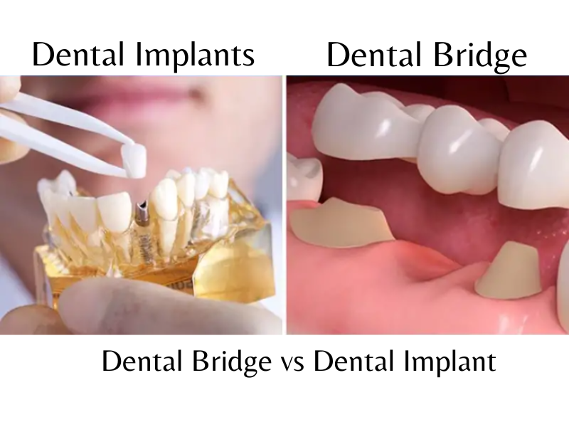 Dental Bridge vs Implant
