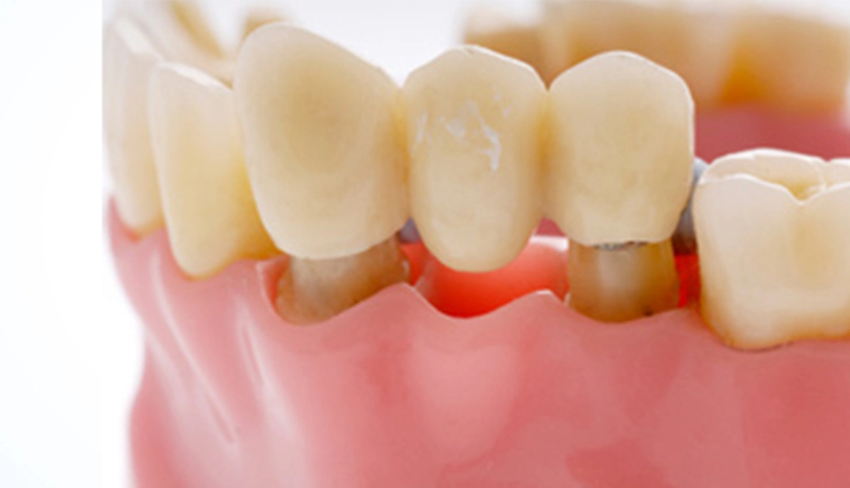 What is a Dental Bridge