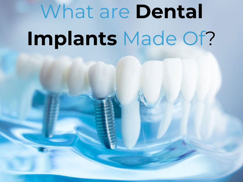 What are Dental Implants Made Of