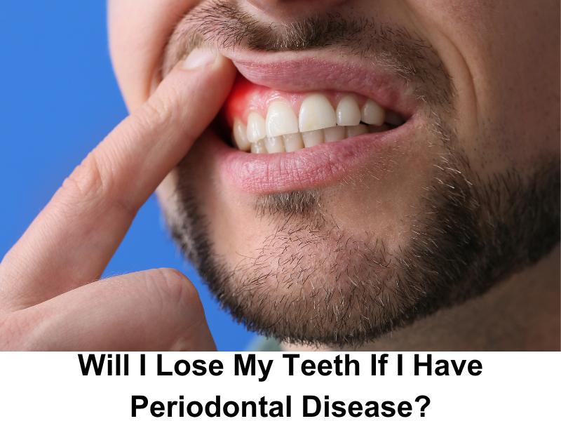Will I Lose My Teeth If I Have Periodontal Disease
