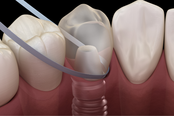 Sign of Dental Implant Failure