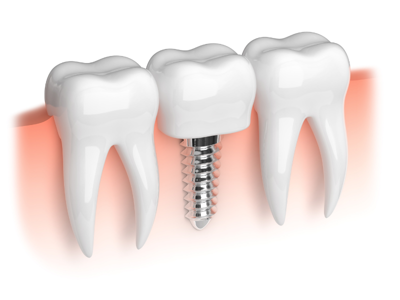 What You Can Expect from Dental Implant Surgery