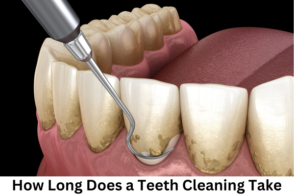 How Long Does a Teeth Cleaning Take