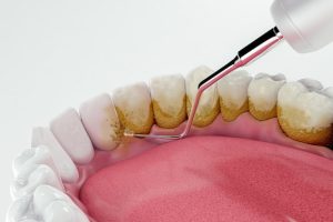 how long does a dental cleaning take