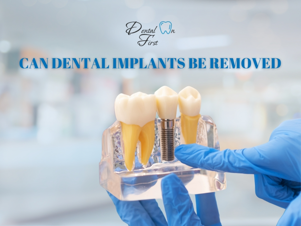 Can Dental Implants Be Removed