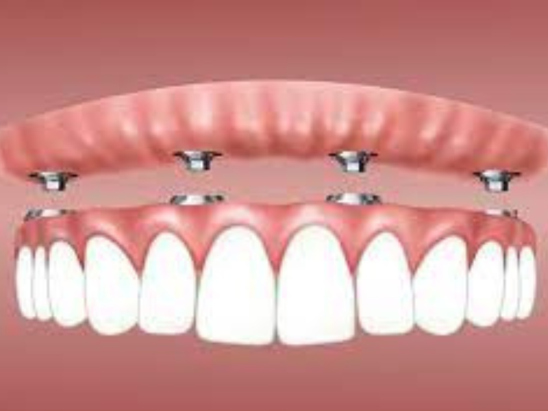Dental Implants be Removed & Replaced with Dentures