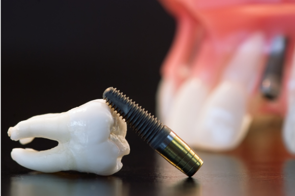 Reasons Why Dental Implants May Need to be Removed