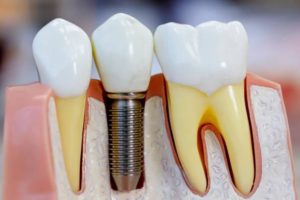 Dental Implant