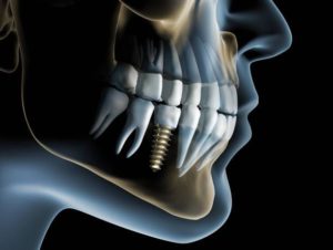 dental implant in the jaw