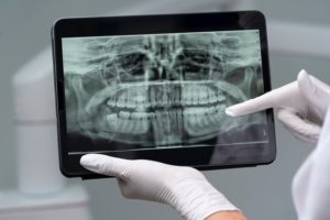 types of dental x rays