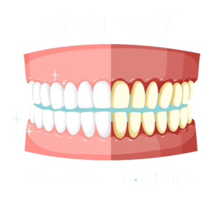 periodontitis