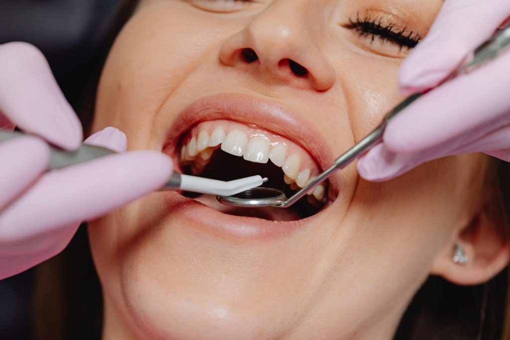 composite tooth filling
