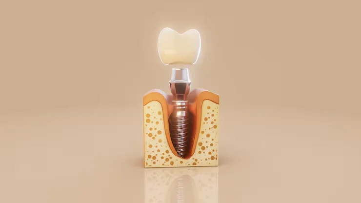 Types of Dental Implants