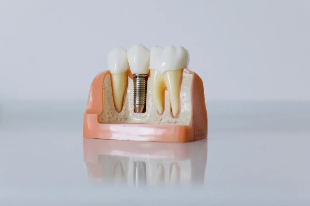 different types of dental implants