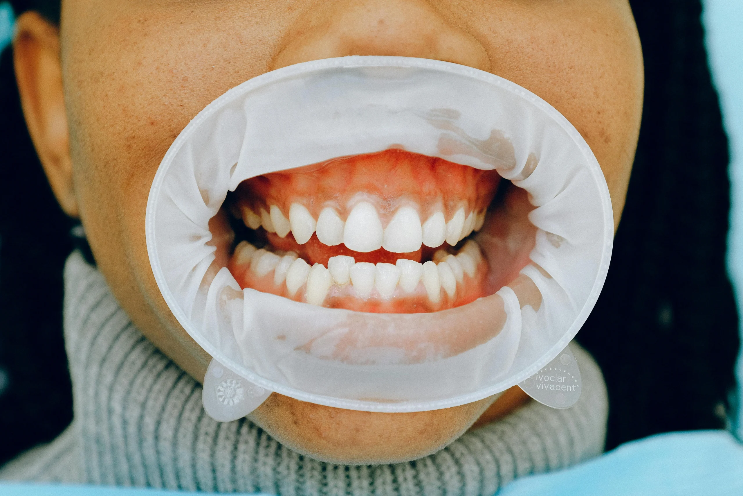 Gum Contouring