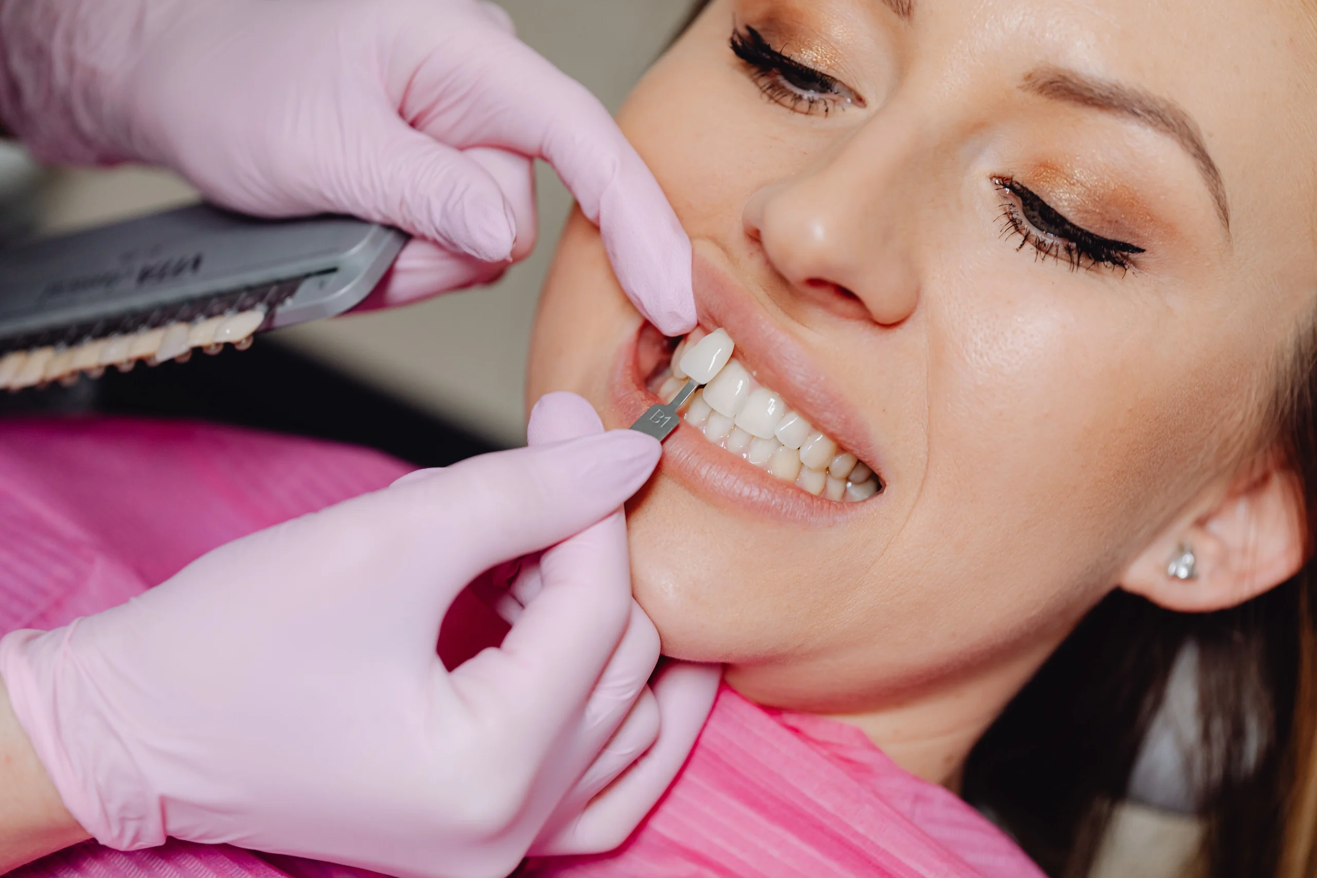 porcelain vs composite veneers